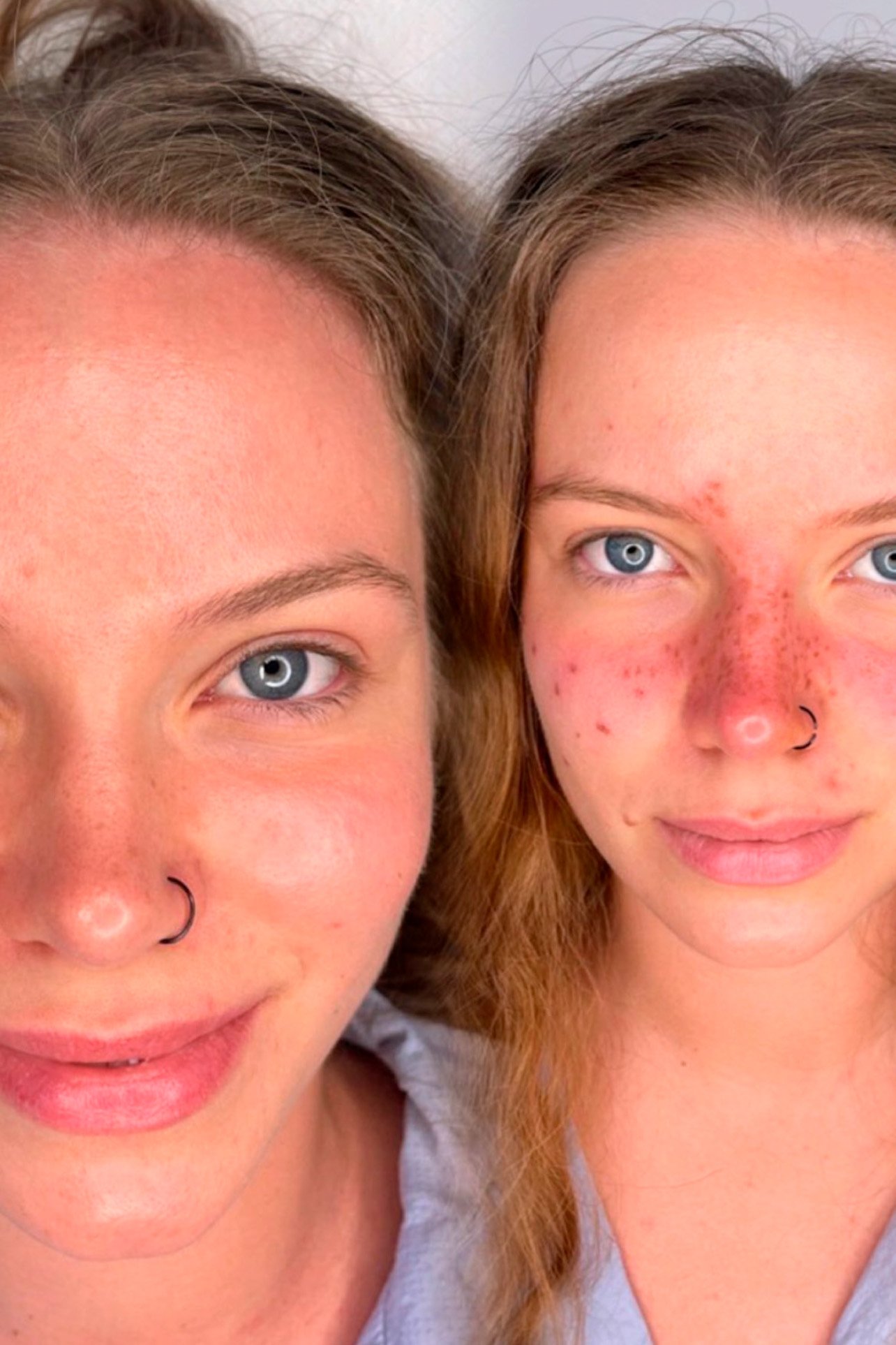 naturalne-piegi-twarz-przed-i-po