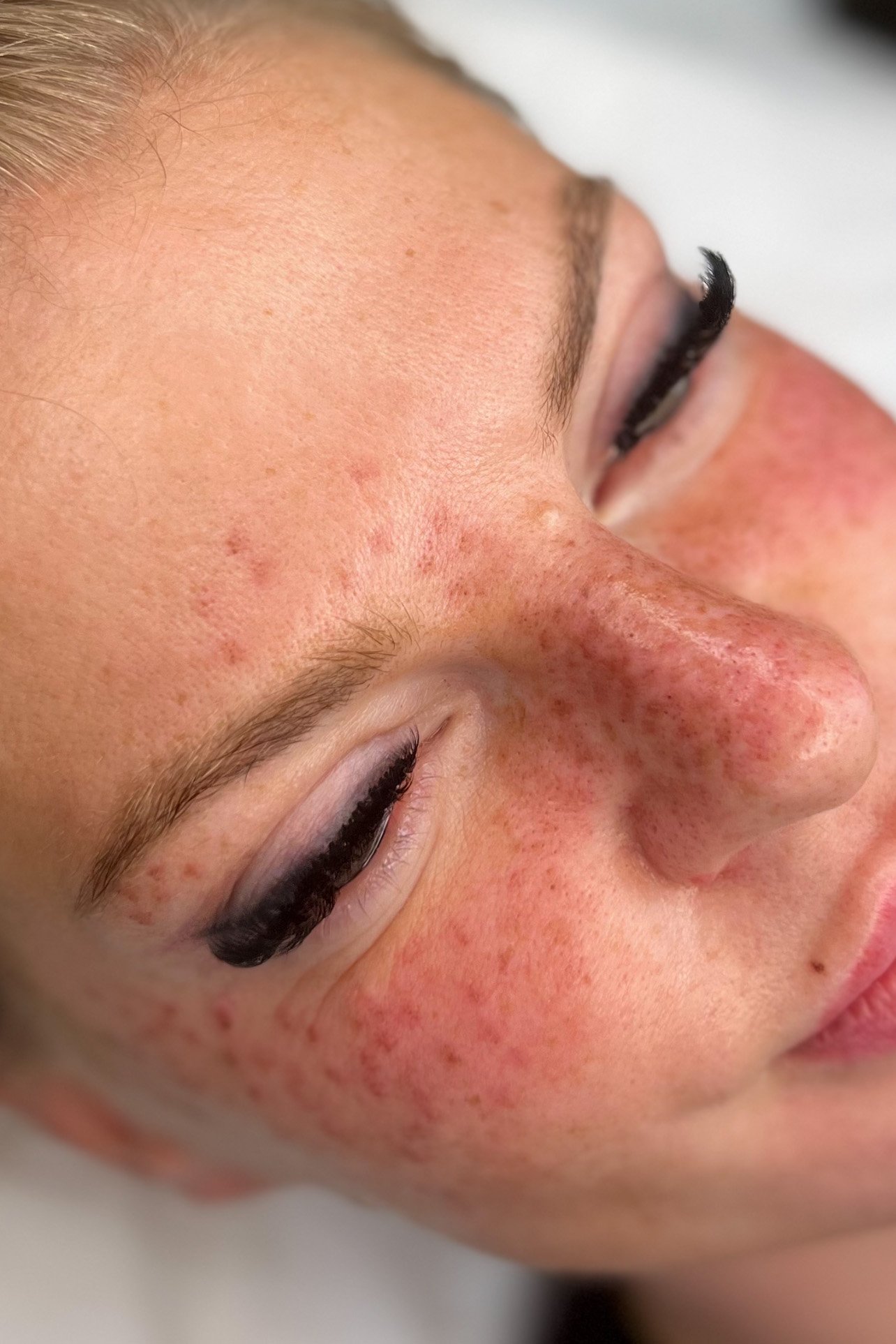 swieze-piegi-bezposrednio-po-zabiegu